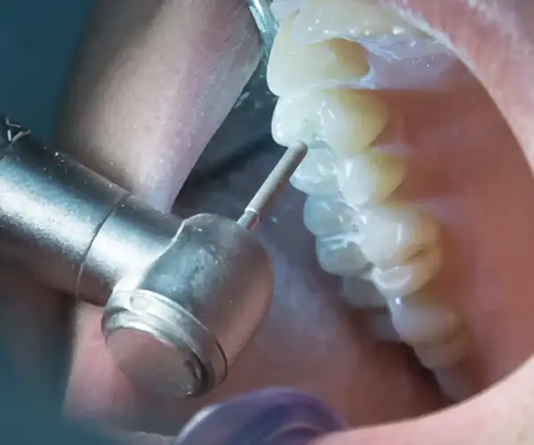 Dettaglio macro di un manipolo odontoiatrico mentre rimuove una lesione cariosa da un dente per prepararlo al restauro.